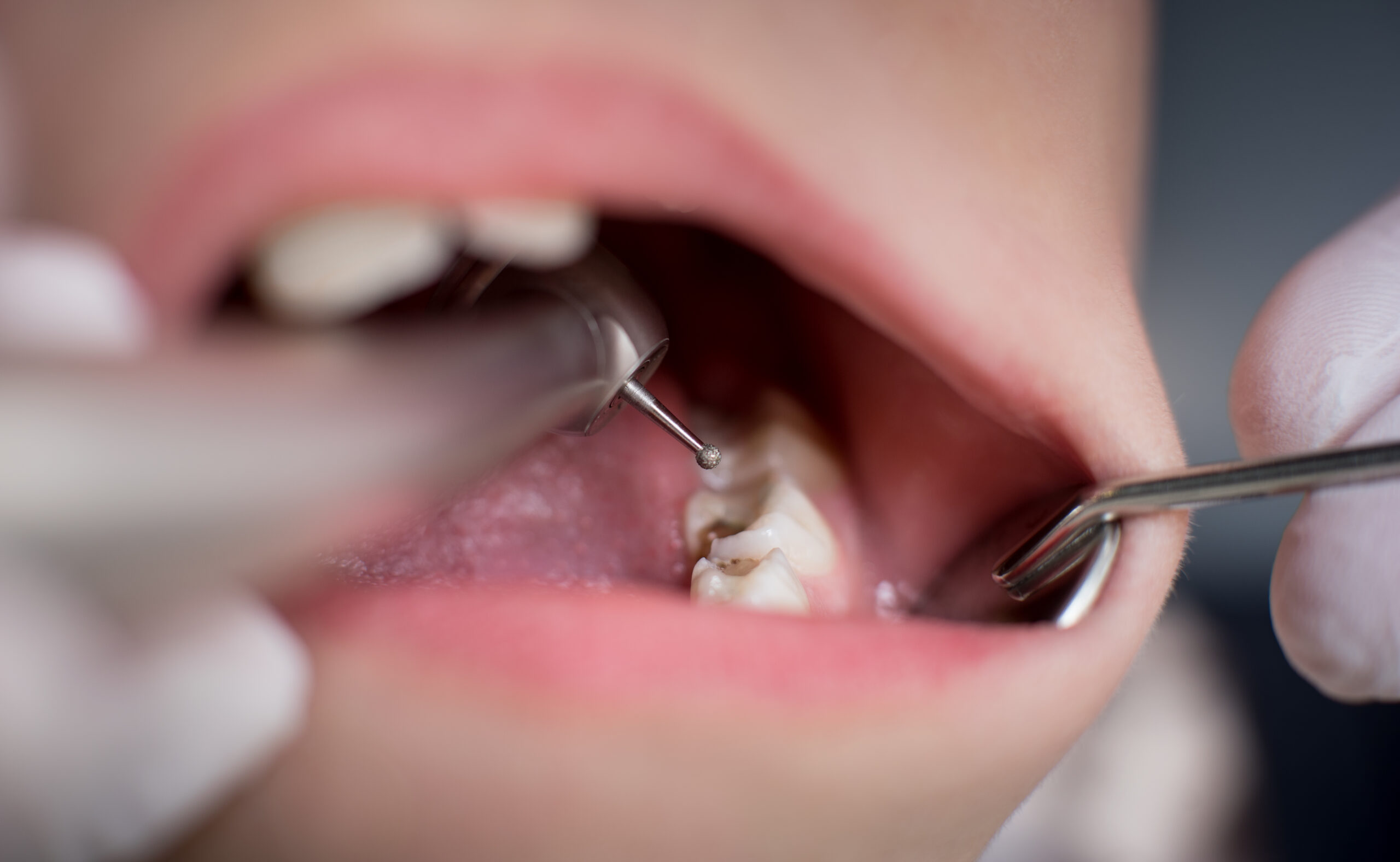 Composite Fillings