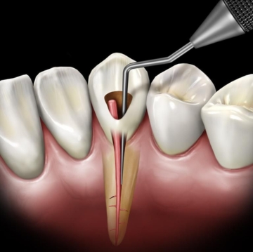 root canal treatment - arch dental