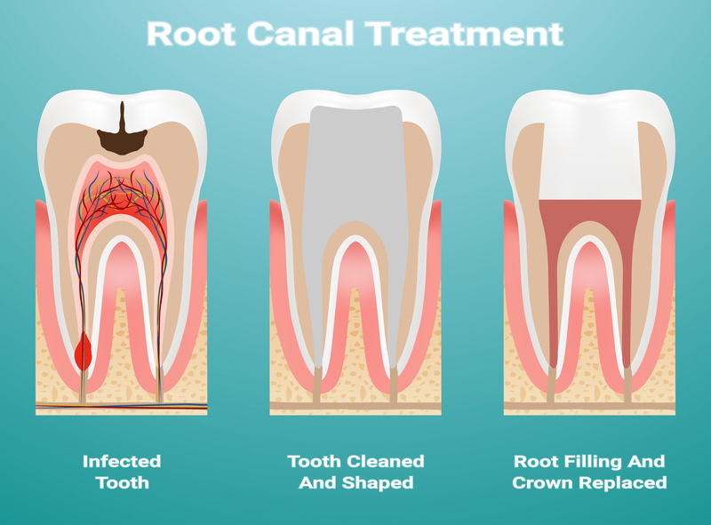 best root canal dentist near me